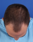 Before Hair Transplant&nbsp;Front